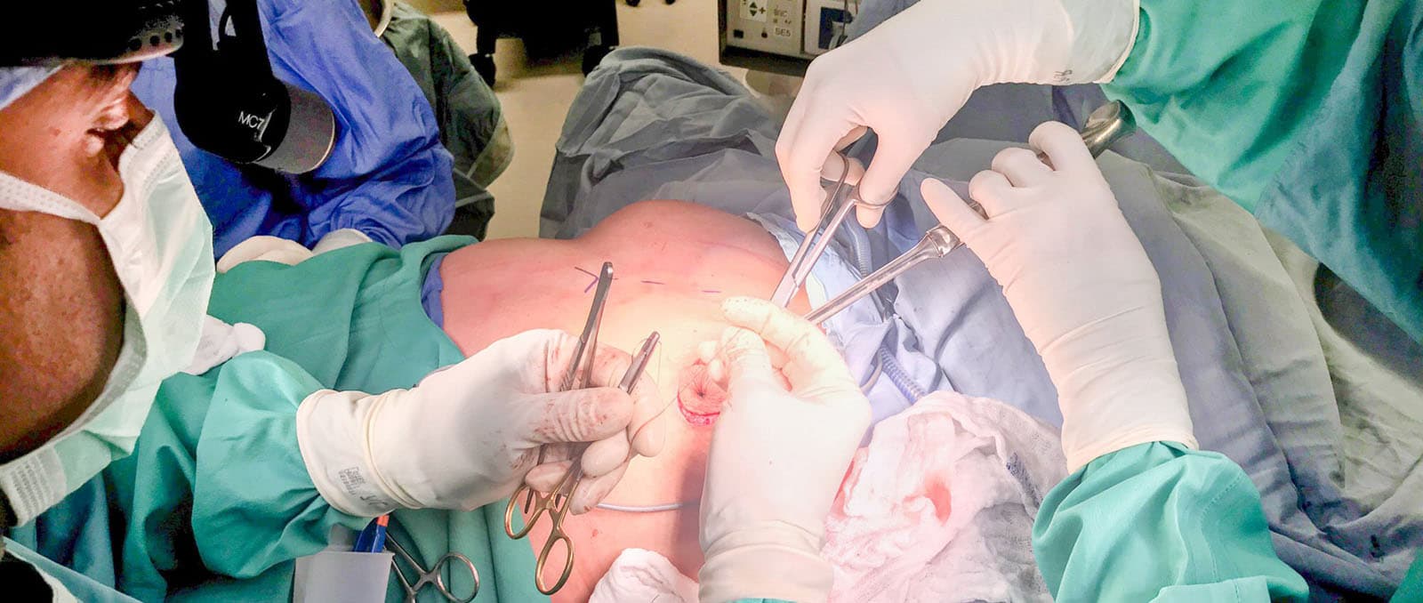 Ihr Weg zur perfekten Brust: Brustvergrößerung mit Implantaten in Bochum