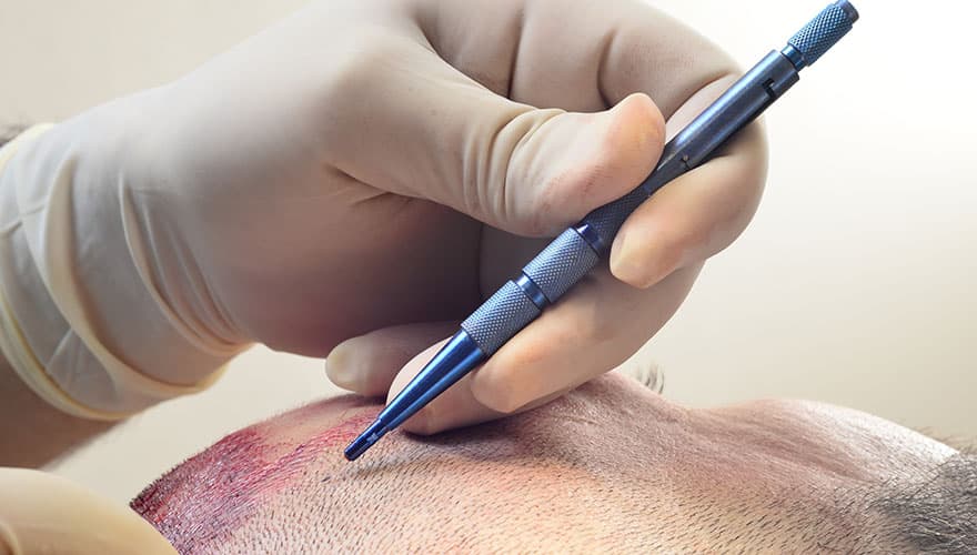Welche Haartransplantationstechnik ist besser: Saphir oder DHI